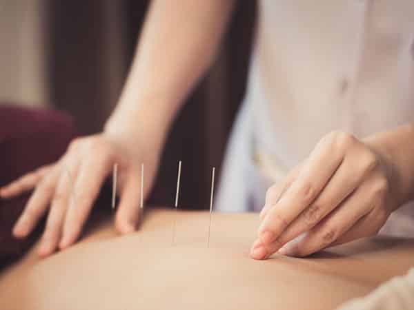 hands applying acupuncture needles to patient