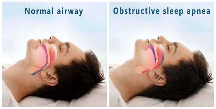 A diagram of how the throat operates during sleep apnea.