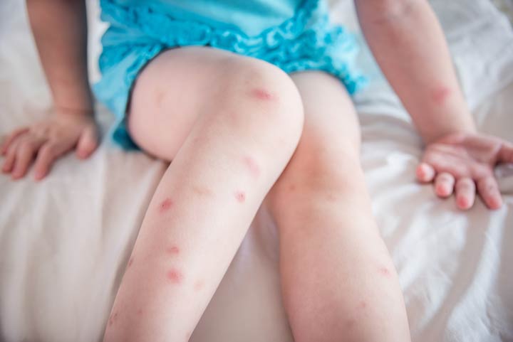 A young girl with bug bites. How to Identify Early Signs of Bed Bugs